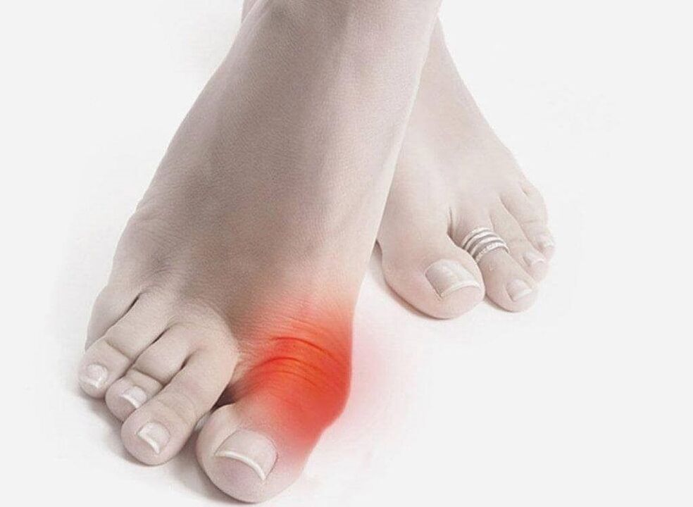 podagras pēdas simptomi
